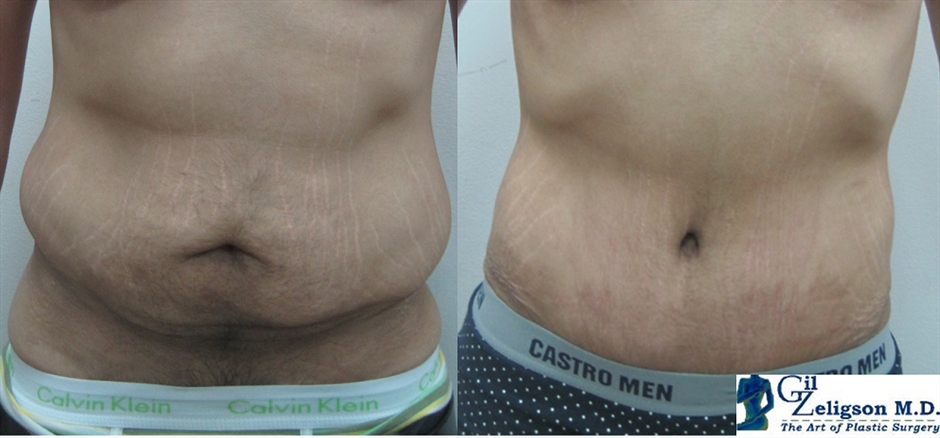 Dr. Gil Zeligson - Tummy Tuck Abdomino plasty