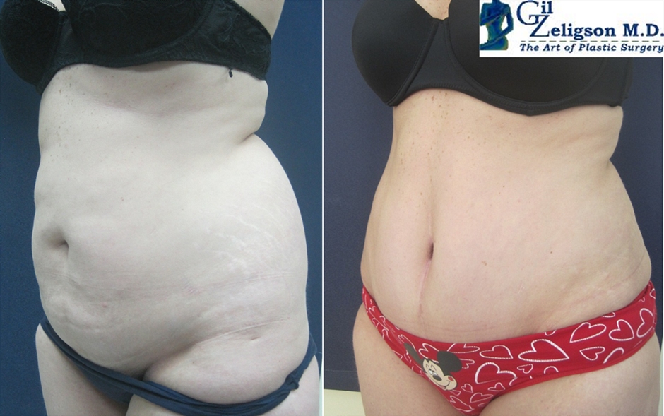Dr. Gil Zeligson - Tummy Tuck Abdomino plasty