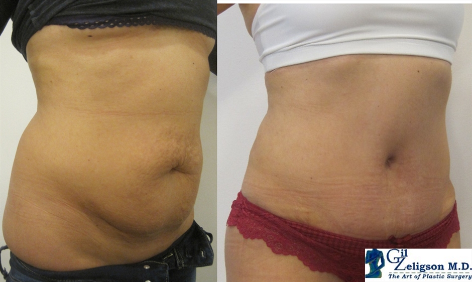 Dr. Gil Zeligson - Tummy Tuck Abdomino plasty