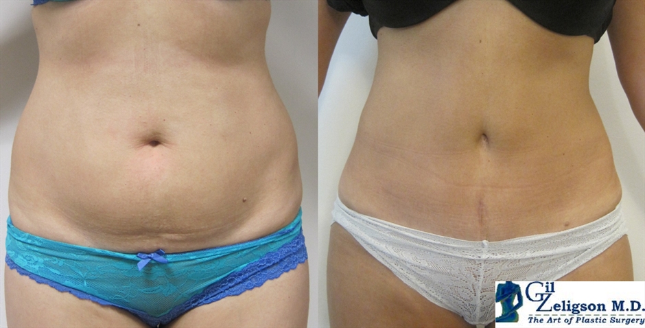 Dr. Gil Zeligson - Tummy Tuck Abdomino plasty