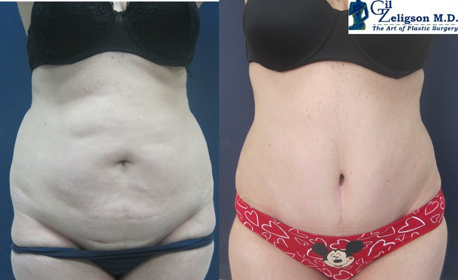 Dr. Gil Zeligson - Tummy Tuck Abdomino plasty