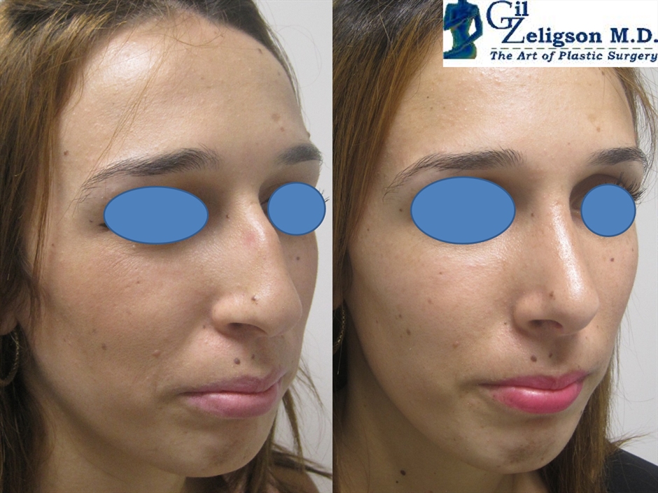 Dr. Gil Zeligson - Rhinoplasty
