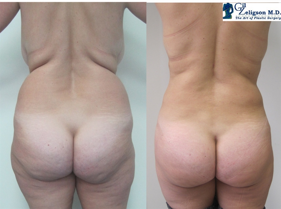 Dr. Gil Zeligson - Liposuction