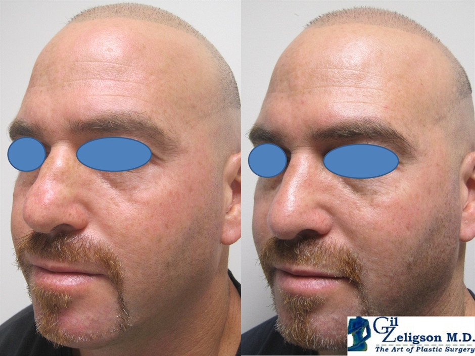 Dr. Gil Zeligson - Rhinoplasty