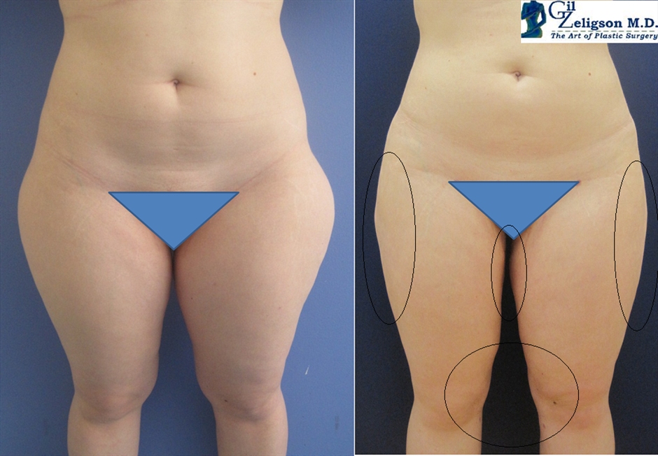 Dr. Gil Zeligson - Liposuction
