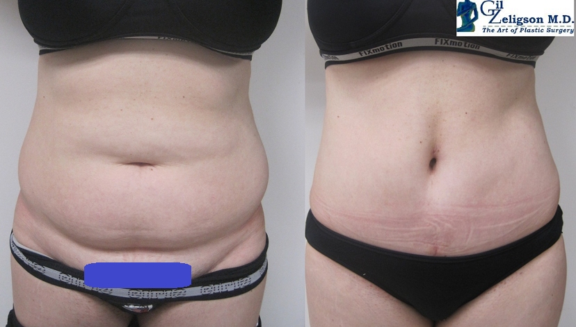 Dr. Gil Zeligson - Tummy Tuck Abdomino plasty