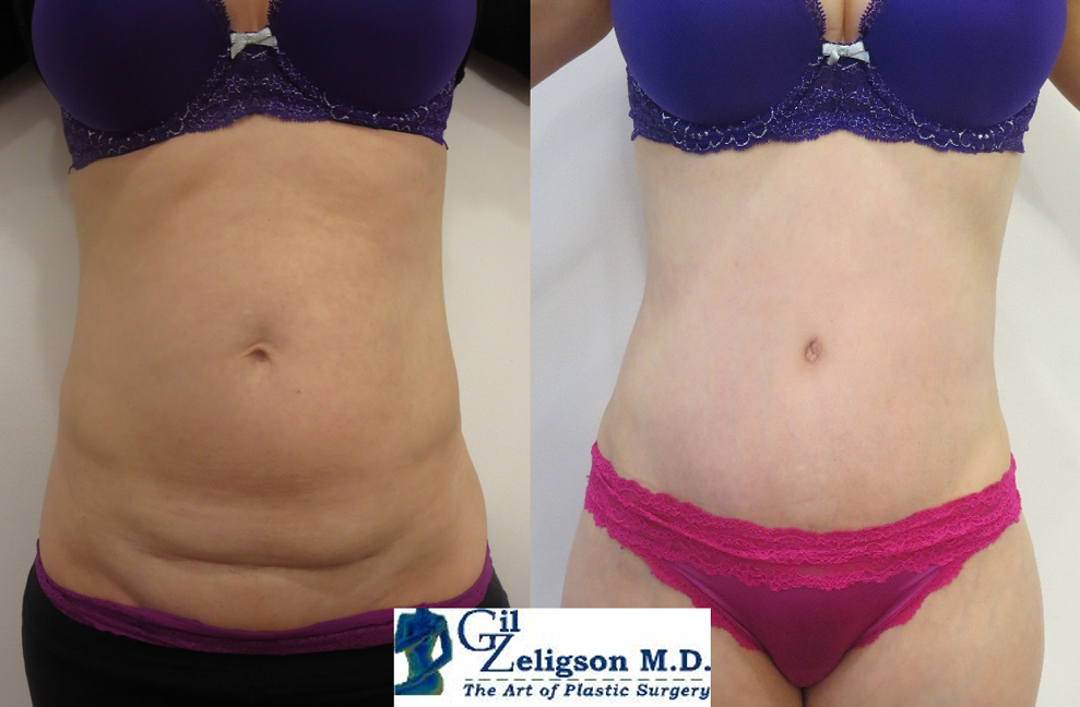 Dr. Gil Zeligson - Tummy Tuck Abdomino plasty