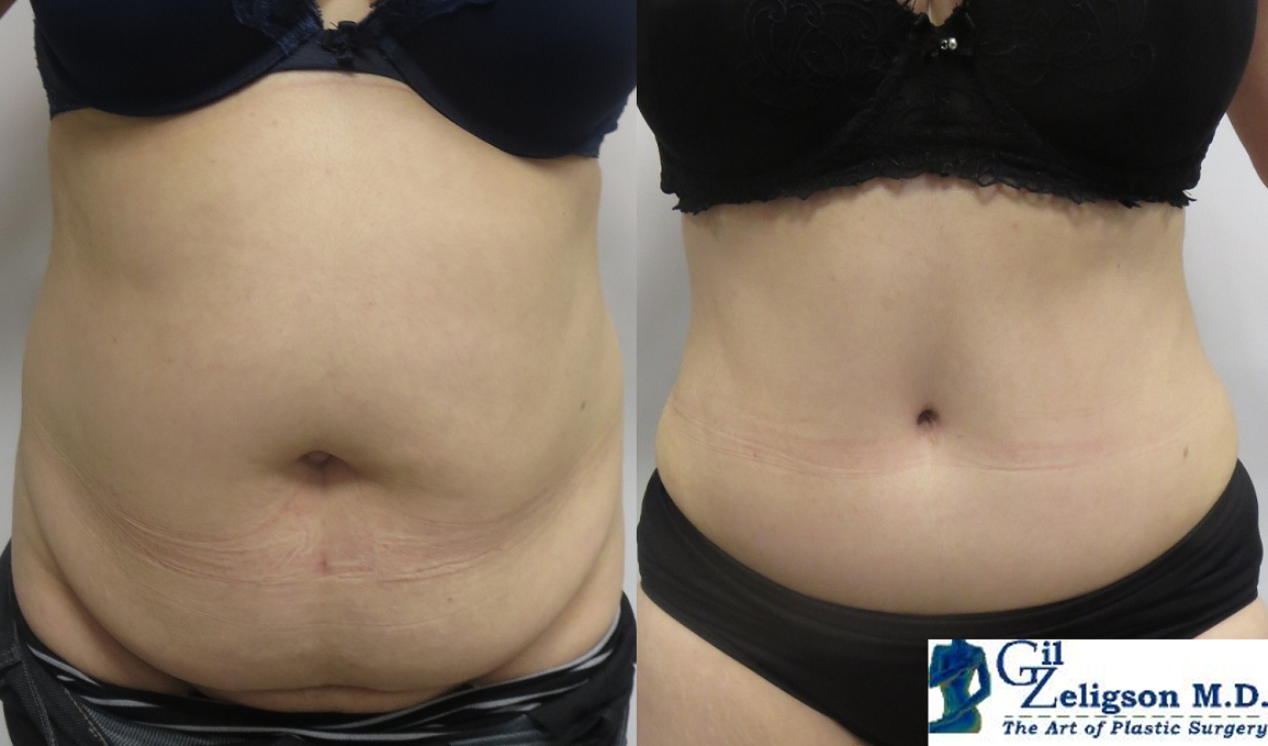 Dr. Gil Zeligson - Tummy Tuck Abdomino plasty