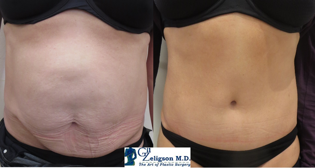 Dr. Gil Zeligson - Tummy Tuck Abdomino plasty