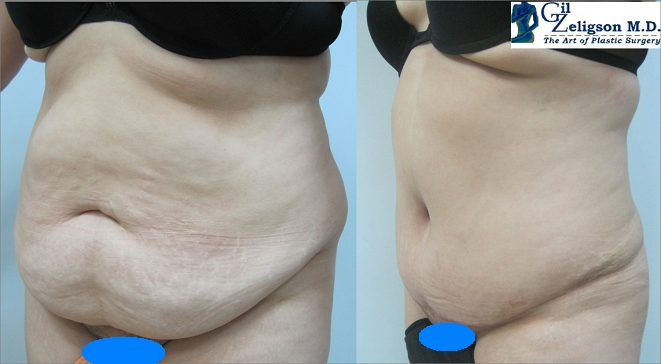 Dr. Gil Zeligson - Tummy Tuck Abdomino plasty