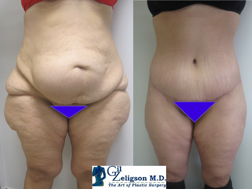 Dr. Gil Zeligson - Tummy Tuck Abdomino plasty