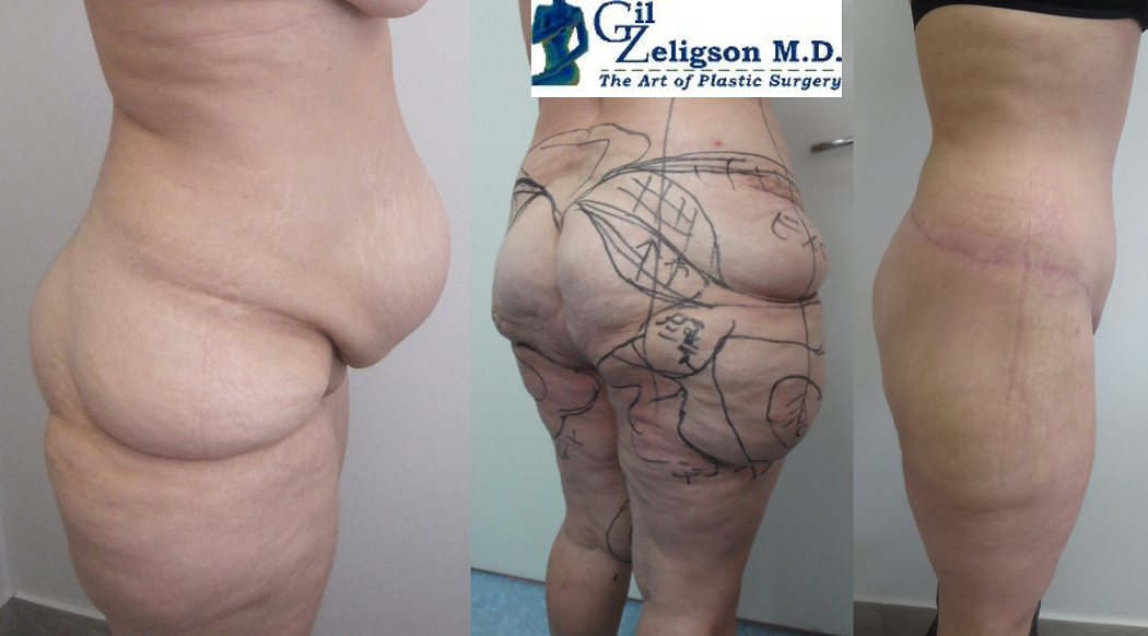 Dr. Gil Zeligson - Tummy Tuck Abdomino plasty
