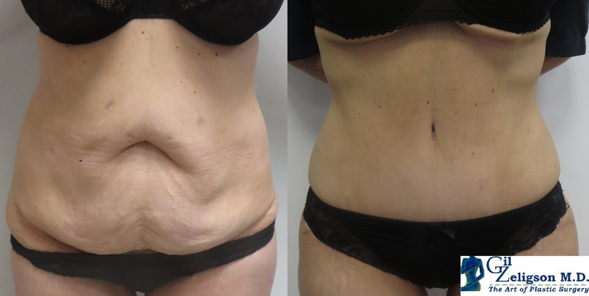 Dr. Gil Zeligson - Tummy Tuck Abdomino plasty
