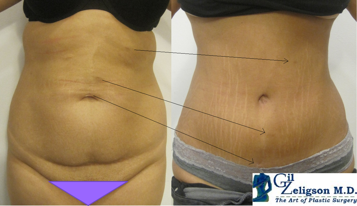 Dr. Gil Zeligson - Tummy Tuck Abdomino plasty