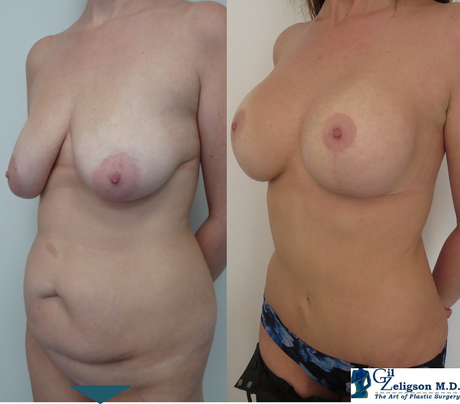 Dr. Gil Zeligson - Tummy Tuck Abdomino plasty