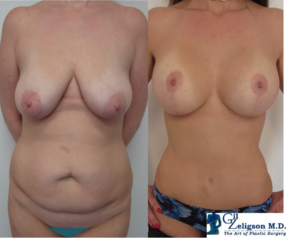 Dr. Gil Zeligson - Tummy Tuck Abdomino plasty