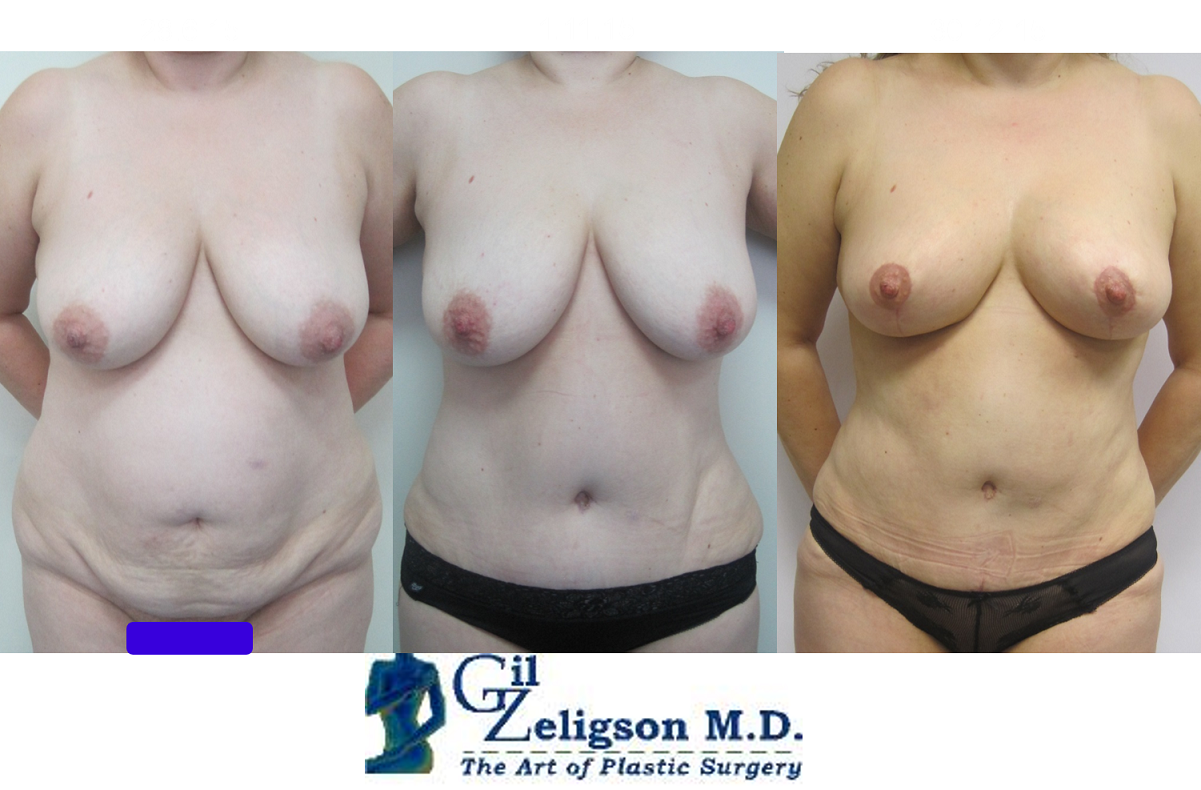 Dr. Gil Zeligson - Breast Reduction