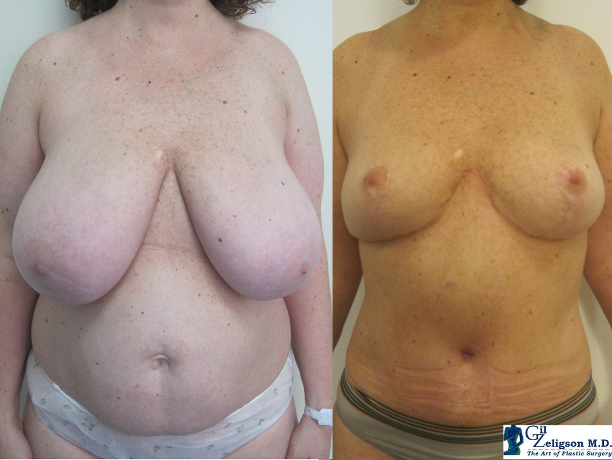 Dr. Gil Zeligson - Breast Reduction