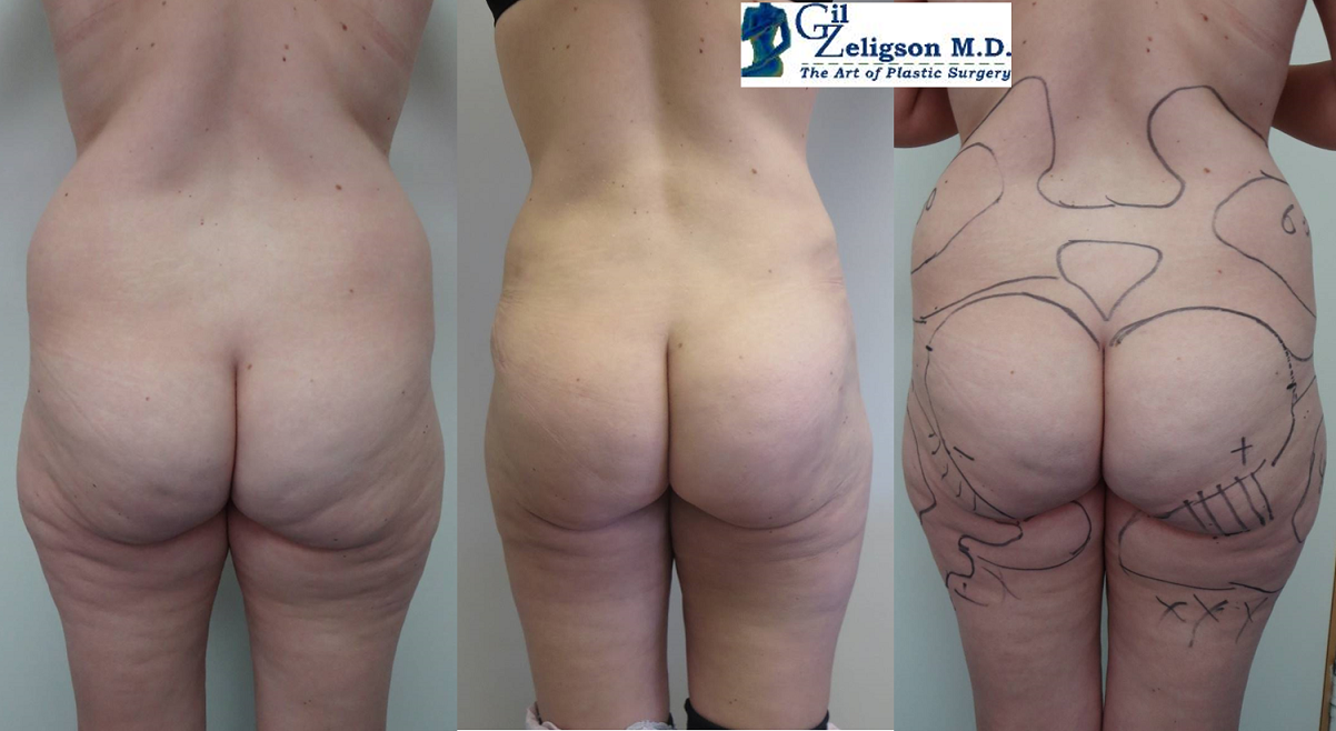 Dr. Gil Zeligson - Liposuction