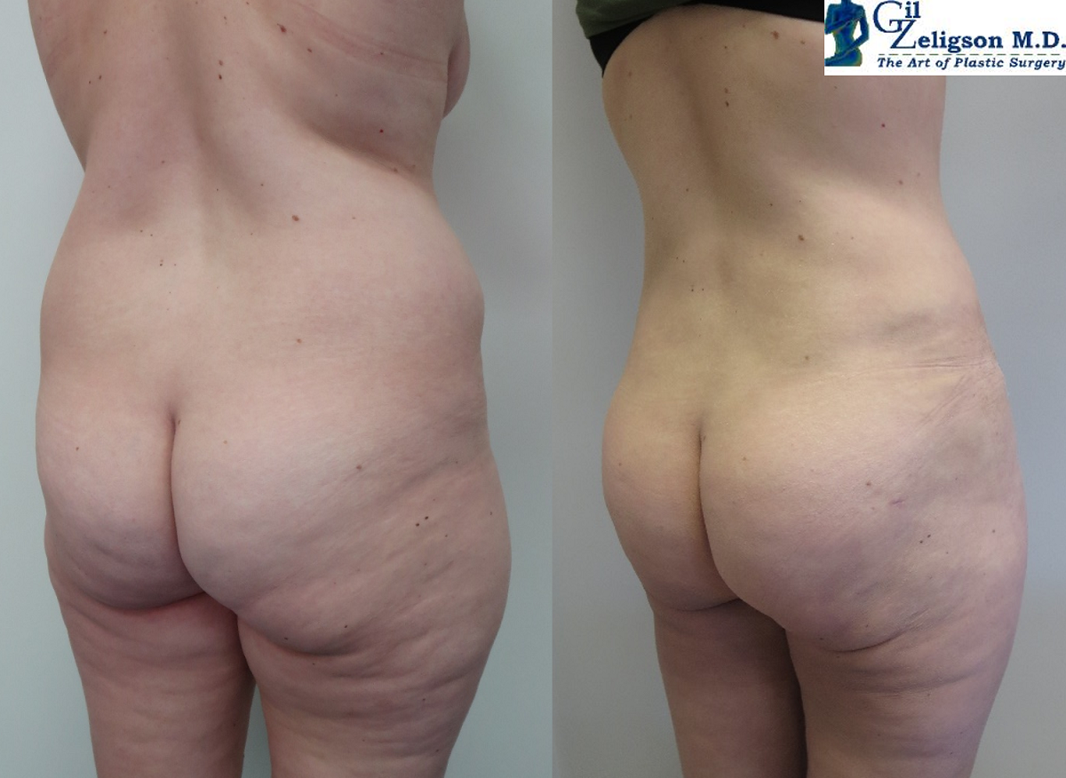 Dr. Gil Zeligson - Liposuction