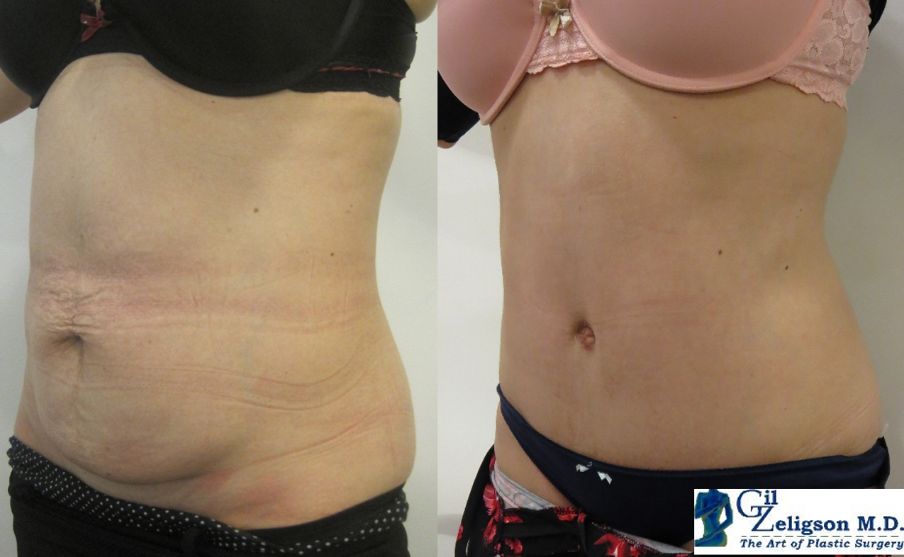 Dr. Gil Zeligson - Tummy Tuck Abdomino plasty