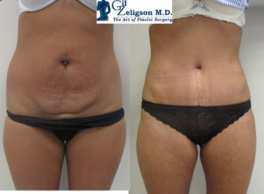 Dr. Gil Zeligson - Tummy Tuck Abdomino plasty