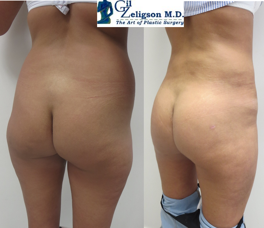 Dr. Gil Zeligson - Liposuction