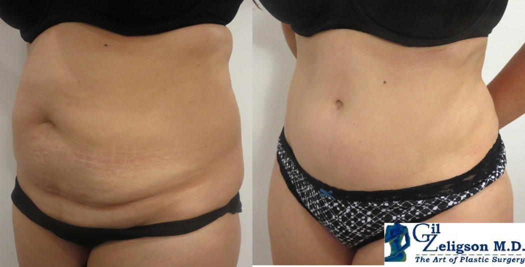 Dr. Gil Zeligson - Tummy Tuck Abdomino plasty