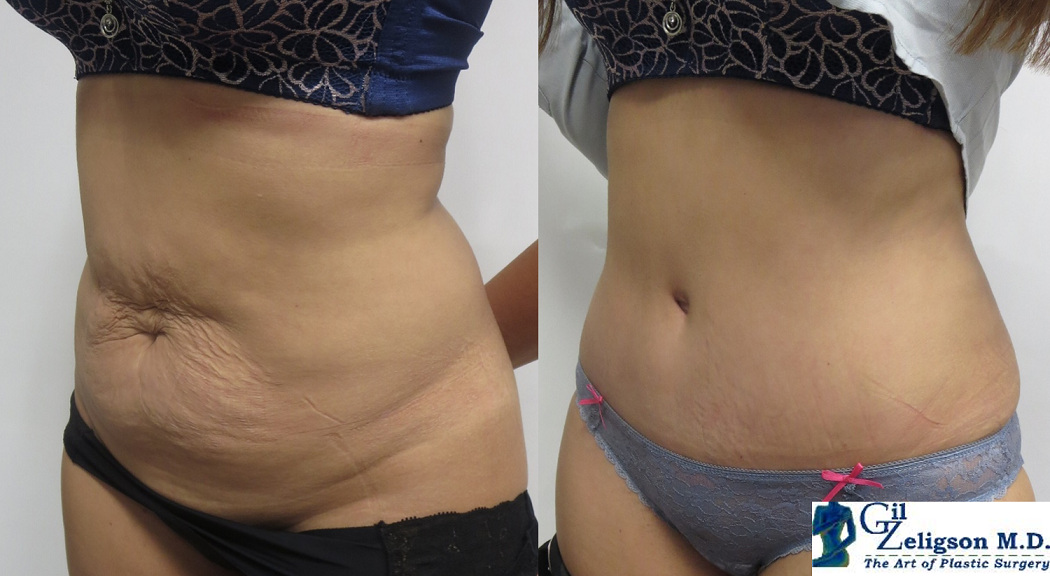 Dr. Gil Zeligson - Tummy Tuck Abdomino plasty