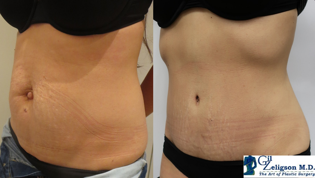 Dr. Gil Zeligson - Tummy Tuck Abdomino plasty