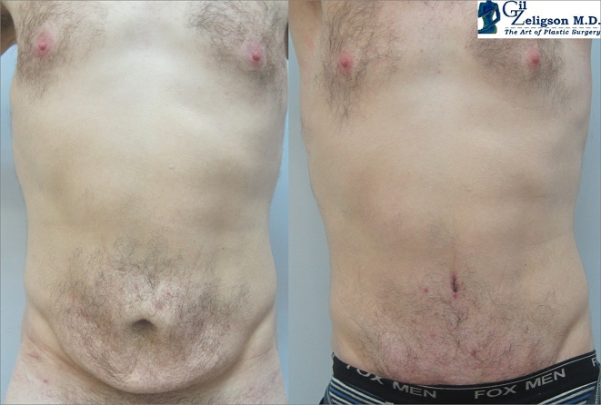 Dr. Gil Zeligson - Tummy Tuck Abdomino plasty