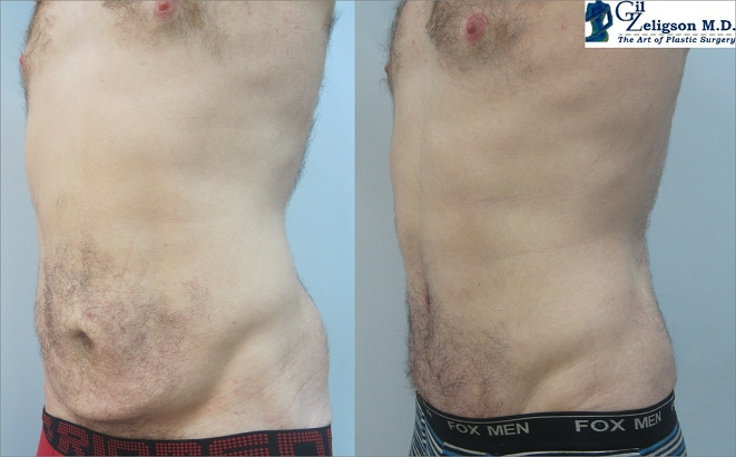 Dr. Gil Zeligson - Tummy Tuck Abdomino plasty