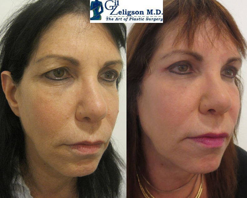Dr. Gil Zeligson - Upper and Lower Eyelids