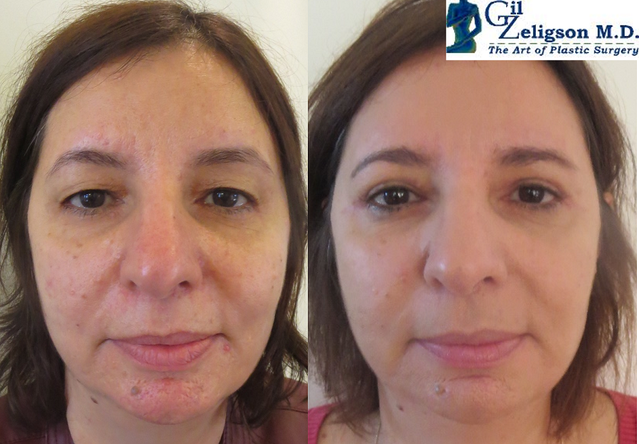Dr. Gil Zeligson - Upper and Lower Eyelids