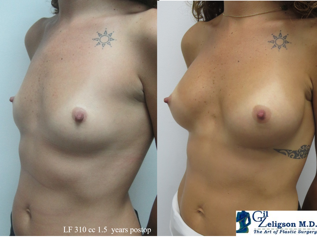 Dr. Gil Zeligson - Breast augmentation