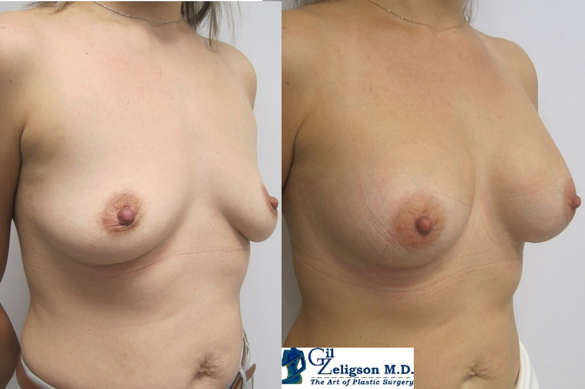 Dr. Gil Zeligson - Breast augmentation
