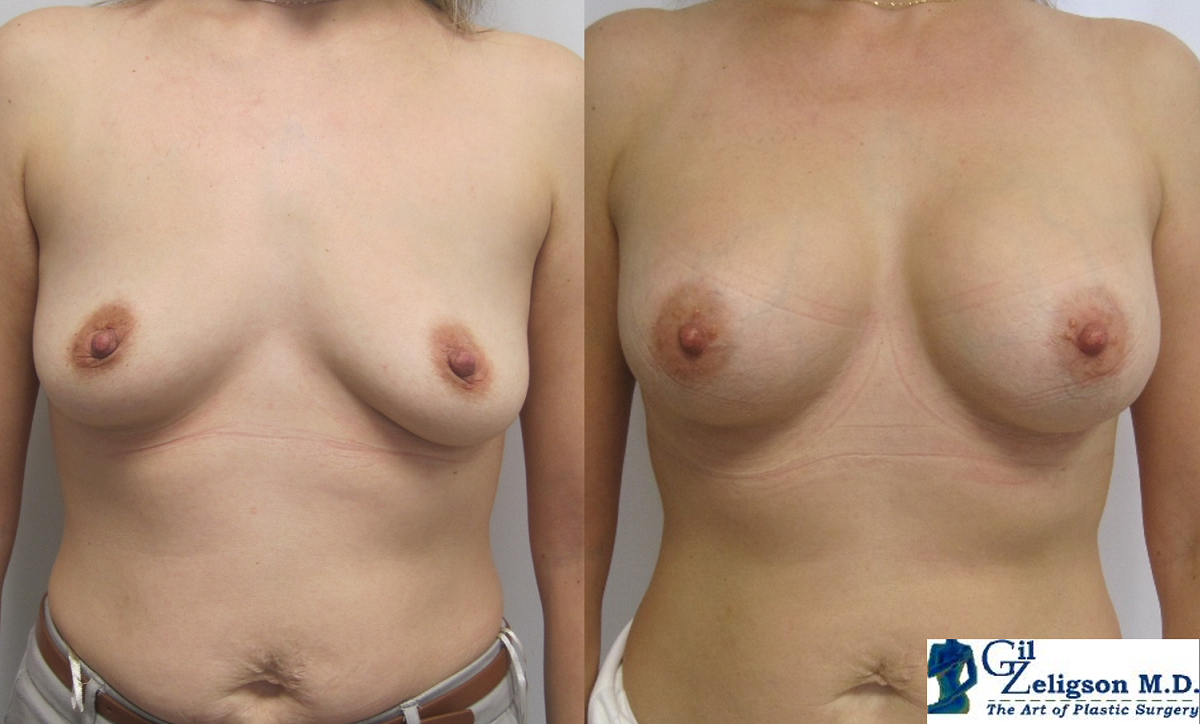 Dr. Gil Zeligson - Breast augmentation