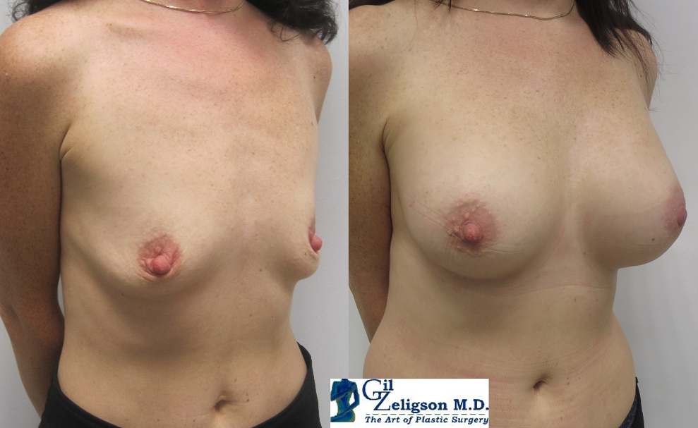 Dr. Gil Zeligson - Breast augmentation