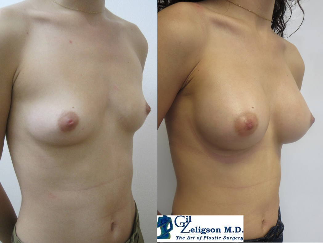 Dr. Gil Zeligson - Breast augmentation