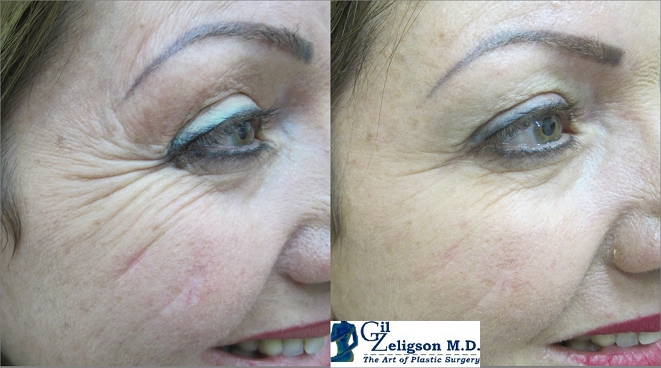 Dr. Gil Zeligson - Botox