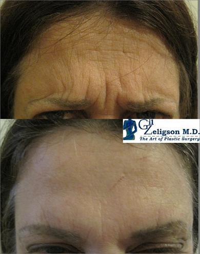 Dr. Gil Zeligson - Botox