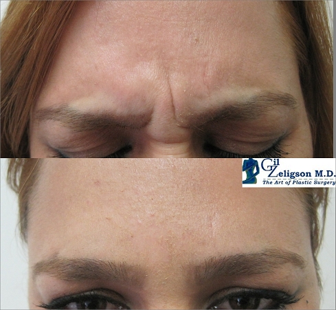 Dr. Gil Zeligson - Botox
