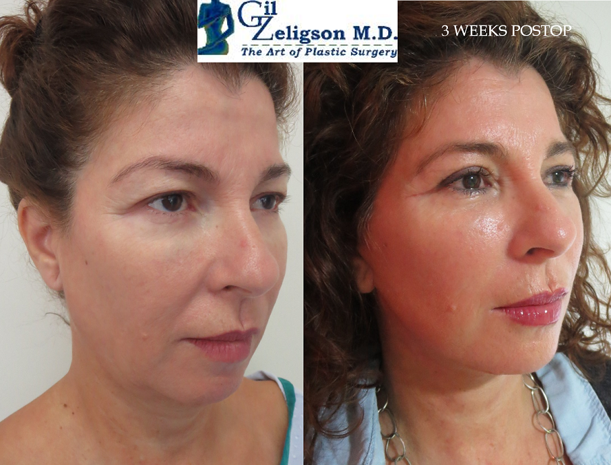 Dr. Gil Zeligson - Facelift