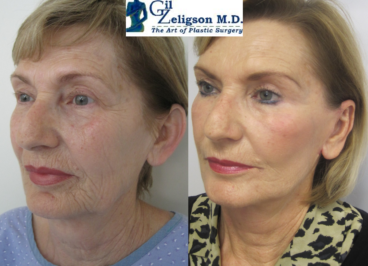 Dr. Gil Zeligson - Otoplasty