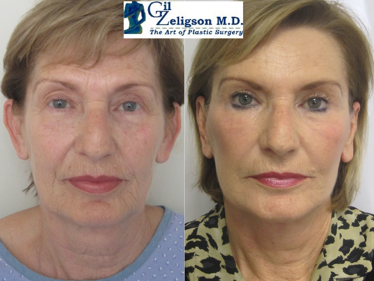 Dr. Gil Zeligson - Facelift