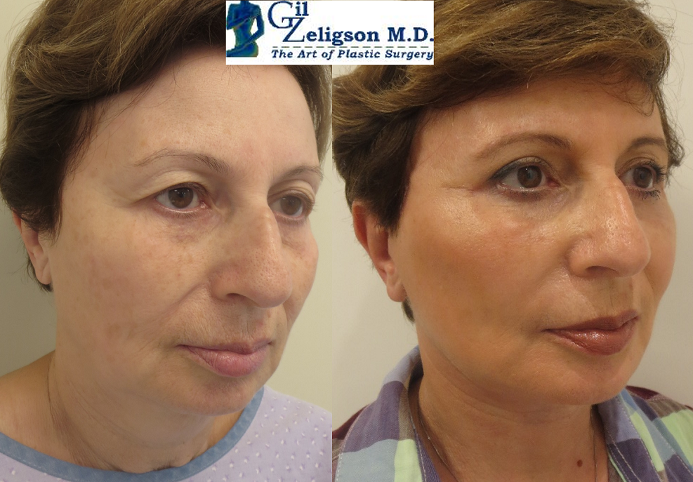 Dr. Gil Zeligson - Facelift