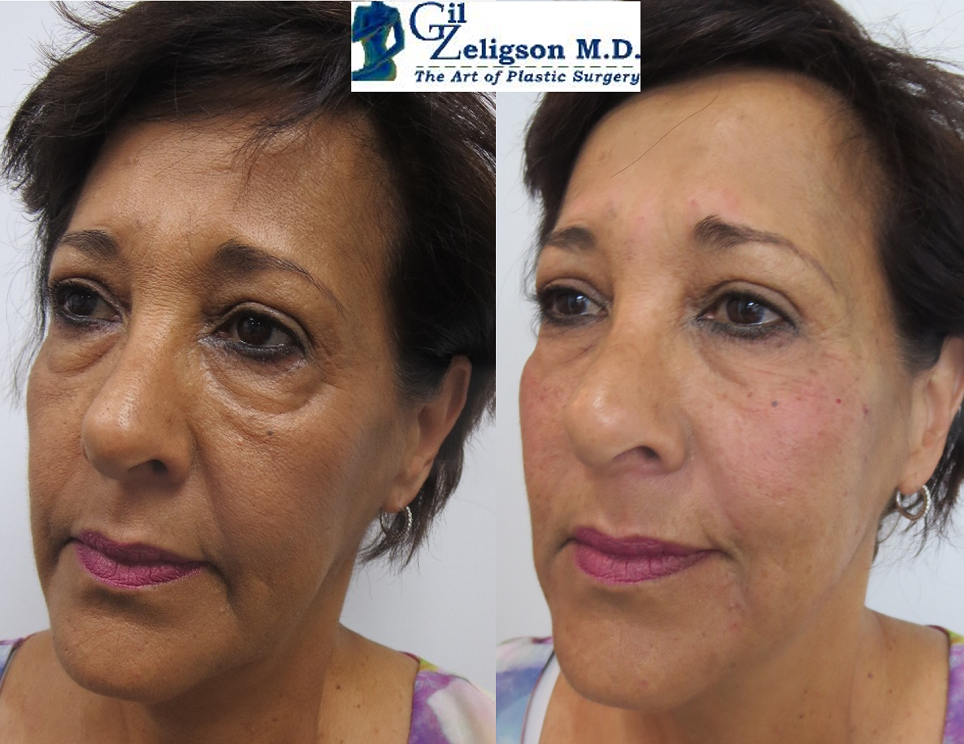 Dr. Gil Zeligson - Facial Sculpturing Hyaluronic acid