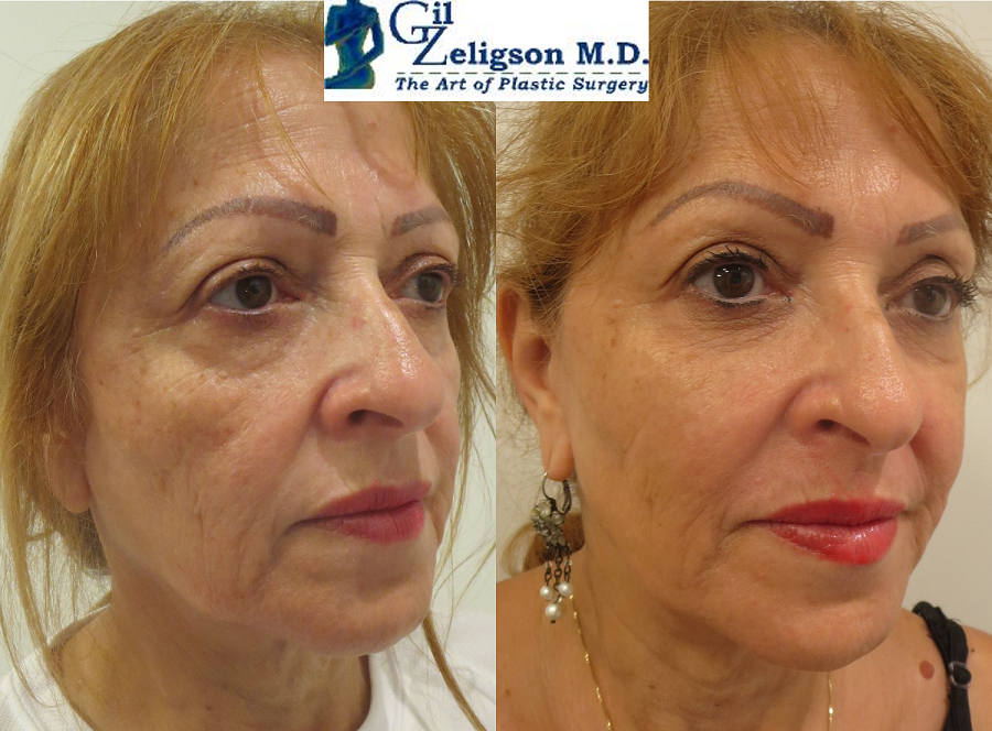 Dr. Gil Zeligson - Facial Sculpturing Hyaluronic acid