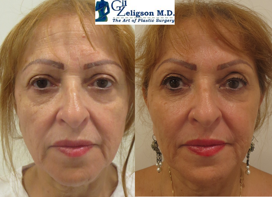 Dr. Gil Zeligson - Facial Sculpturing Hyaluronic acid