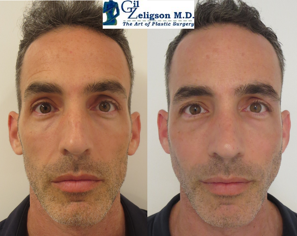 Dr. Gil Zeligson - Facial Sculpturing Hyaluronic acid